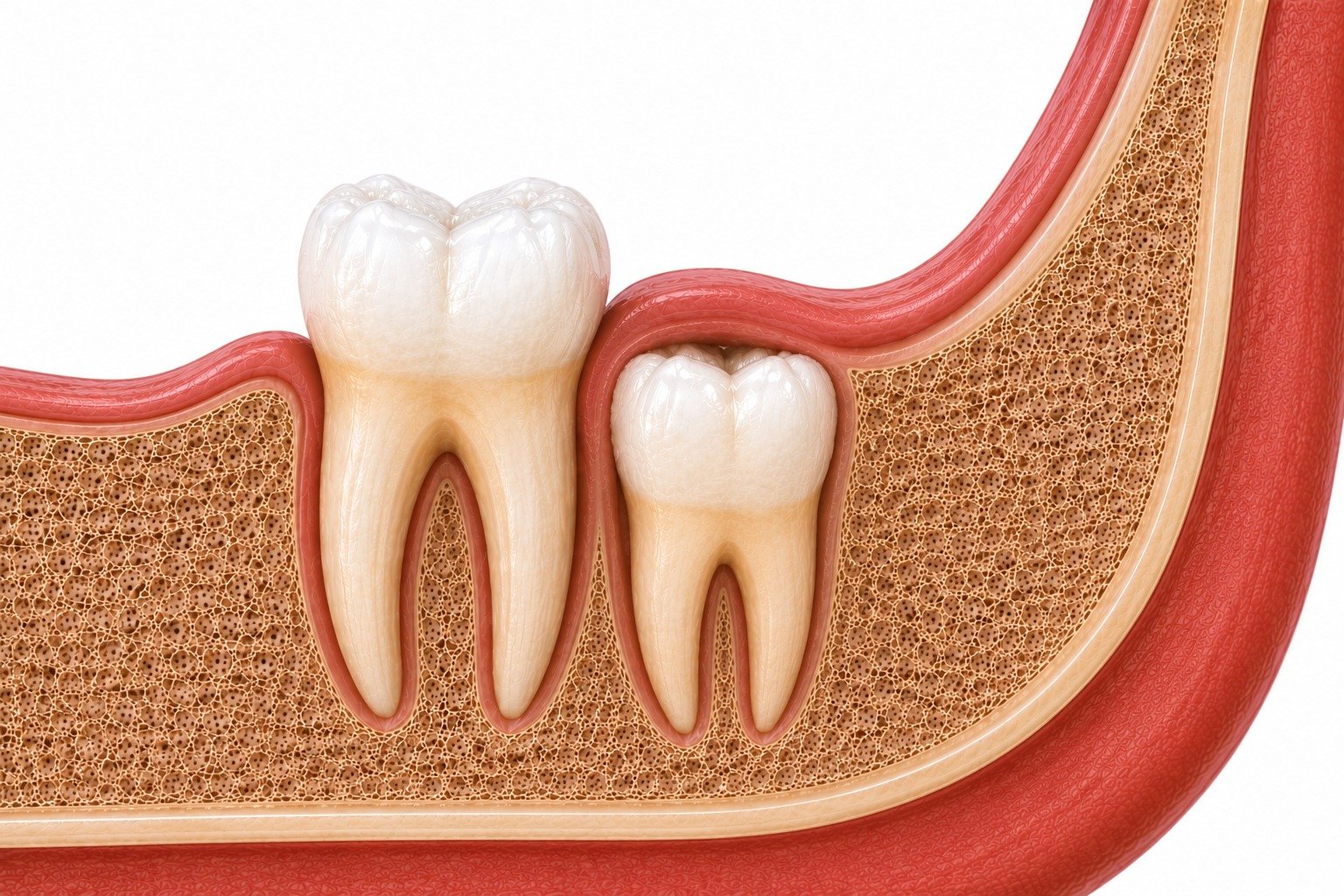 Vertically impacted wisdom tooth trapped inside bone